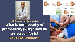 Retinopathy of prematurity in preterm babies Why do we screen for ROP how to treat Dr Sridhar K [upl. by Nettirb]