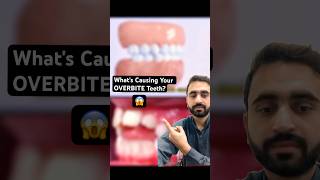 Whats Causing Your OVERBITE Teeth dentist braces orthodontist allaboutbraces [upl. by Accire]