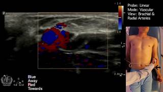 Vascular Doppler using Ultrasound Made Simple [upl. by Anairb]