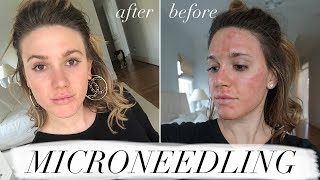 MY FIRST MICRONEEDLING EXPERIENCE amp WHAT TO EXPECT ACNE SCAR TREATMENT [upl. by Annaerb306]