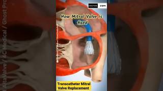 Transcatheter mitral Valve Replacement TMVR shorts [upl. by Annala]