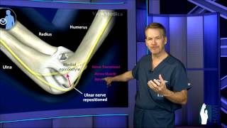 Cubital Tunnel Surgery [upl. by Nuhsed]