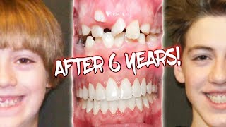 6 YEARS OF BRACES BEFORE AND AFTER TRANSFORMATION [upl. by Jessen]