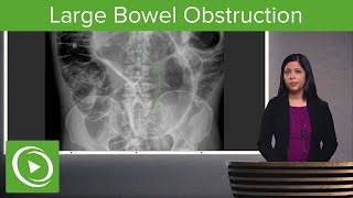 Bowel Obstruction and Ileus Large Bowel Obstruction amp Ogilvie Syndrome – Radiology  Lecturio [upl. by Ottinger]