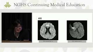 Neuroscience Grand Rounds Cryptococcal Meningitis [upl. by Terrel736]