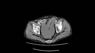 hemoperitoneuminjury small bowel A [upl. by Krischer]