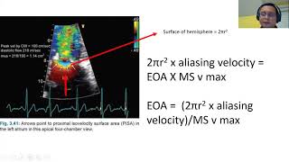 Prosthetic mitral valve assessment [upl. by Bolanger266]