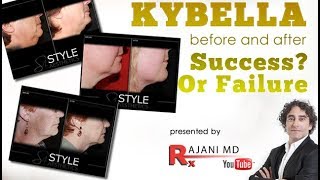 Watch Kybella Injection  Before and Afters Fat Double Chin Reduction [upl. by Odell1]