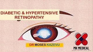 Diabetic amp Hypertensive retinopathy [upl. by Aven]