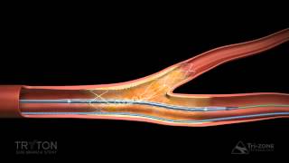 Tryton Side Branch Stent Deployment Sequence [upl. by Brecher]