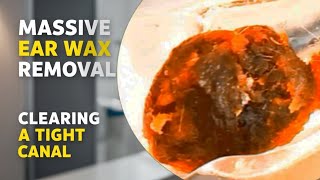 Clearing a Tight Ear Canal of Massive Ear Wax [upl. by Enileve87]