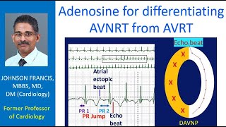 Adenosine for differentiating AVNRT from AVRT [upl. by Cheatham]