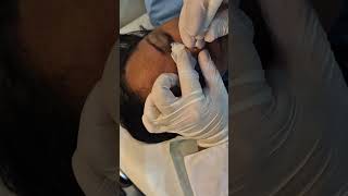 Retirada de sinal do nariz Nose mole removal [upl. by Stanislaus90]