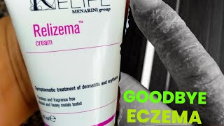 Goodbye Dyshidrotic eczematous dermatitis using this eczema [upl. by Emilia]