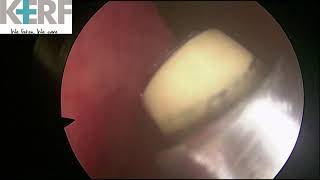 Endoscopic Coblator assisted Bleeding Nasal polyp excision [upl. by Boyer]