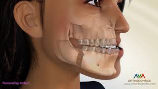 Surgical Orthodontic Treatment for Underbite or Crossbite  Transcortical Mandibular Setback [upl. by Etakyram]