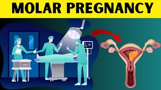 Molar Pregnancy Explained Types Symptoms Diagnosis and Treatment Hydatidiform Mole Overview [upl. by Aikyn]