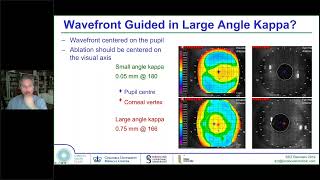 Laser Eye Surgery Topography or WavefrontGuided TransPRK Vs LASIK Vs SMILE Vs ICL [upl. by Hamish]