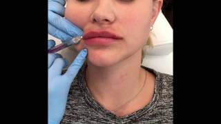 Juvederm Volbella Lip Filler Enhancment with Before and After Photos [upl. by Nehemiah434]