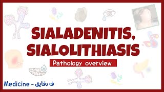 Sialadenitis amp Sialolithiasis  salivary gland diseases pathology overview head amp neck surgery شرح [upl. by Sverre277]