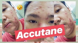 MY ACCUTANE JOURNEY ISOTRETINOIN REVIEW plus 2 MONTH UPDATE amp SIDE EFFECTS [upl. by Assilana]