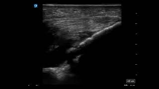 Elbow Ultrasound Arthrocentesis [upl. by Ciryl363]