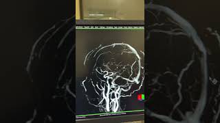 Mri Brain Venography mri radiology Radiologydept [upl. by Salmon]