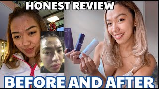 CUROLOGY REVIEW BEFORE AND AFTER  DOES IT WORK  My Severe Acne Story [upl. by Perdita829]