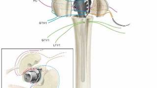 Equinoxe Platform Fracture Suture Animation [upl. by Amann]