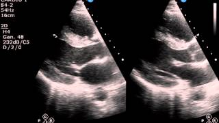 ECOCARDIOGRAMA NORMAL [upl. by Irvin]