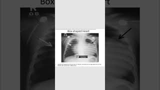 Box shaped heart ebstein anomalyradiology cardiologyneetpg inicet shortsfeed [upl. by Le]