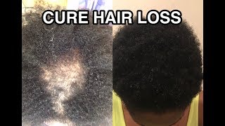 HOW TO CURE HAIR LOSS AND ALOPECIA FAST [upl. by Adalai]