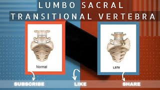 LUMBOSACRAL TRANSITIONAL VERTEBRAE  LSTV  LUMBARIZATION  SACRALIZATION  BERTOLOTTI SYNDROME [upl. by Ativet]