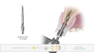 Guided surgery Astra Tech Implant System ® EV [upl. by Okim]