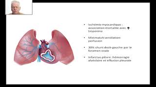 Embolie pulmonaire 2020 partie 1 [upl. by Gerk]