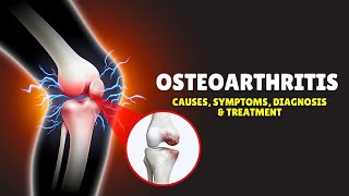 Osteoarthritis – Causes Signs and Symptoms Diagnosis amp Treatment [upl. by Nileuqcaj901]