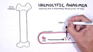 Haemolytic Anaemia  classification intravascular extravascular pathophysiology investigations [upl. by Yarrum]