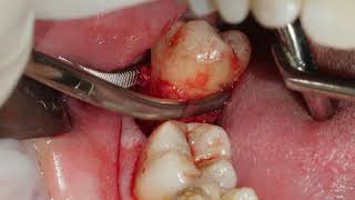 A 48 erupted wisdom tooth extraction [upl. by Kwapong477]