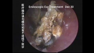 Cerumen mixed fungi similar to cholesteatoma 20231230 [upl. by Ennaej]