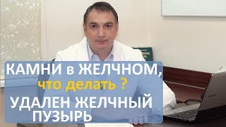 Камни в желчном пузыре симптомы лечение Удален желчный  последствия операции и что делать [upl. by Atekihc]