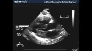 TheEchoWeb  Tetralogy of Fallot [upl. by Leila]