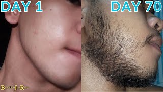 Minoxidil Beard Journey 10 WEEK TRANSFORMATION [upl. by Julianna]