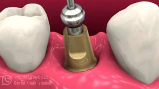 Dental implant ölçü işlemleri [upl. by Yesor]