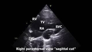 Right Parasternal Echo View [upl. by Lauree]