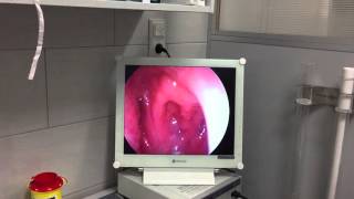 Endoscopic examination of normal nasal cavity [upl. by Eipper]