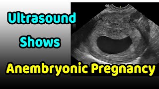 Ultrasound Shows Anembryonic Pregnancy [upl. by Florry804]