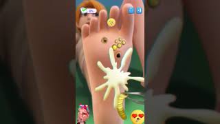 Wart Removal animation satisfying funny relax story game [upl. by Ennairb716]