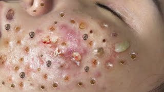 Loan Nguyen Acne Treatment 1623 [upl. by Jordon440]