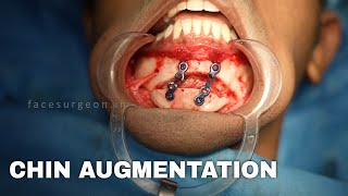 Chin Implant Surgery for Male  PLASTIC with Dr Sunil Richardson [upl. by Aerbma662]