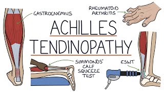 Understanding Achilles Tendinopathy Achilles Tendinitis [upl. by Neyu648]